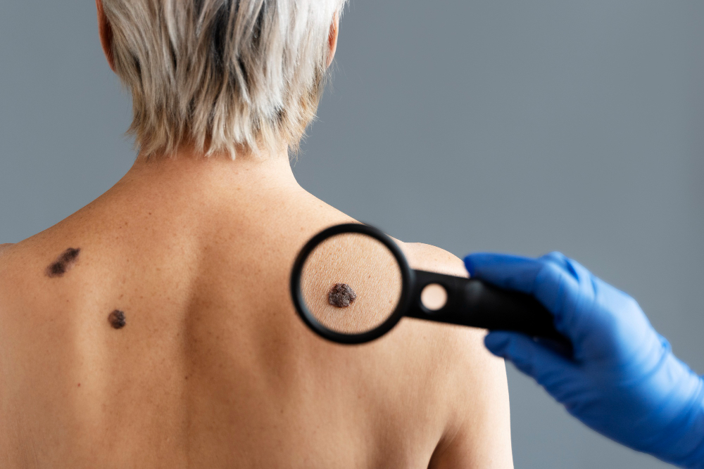 Birthmark